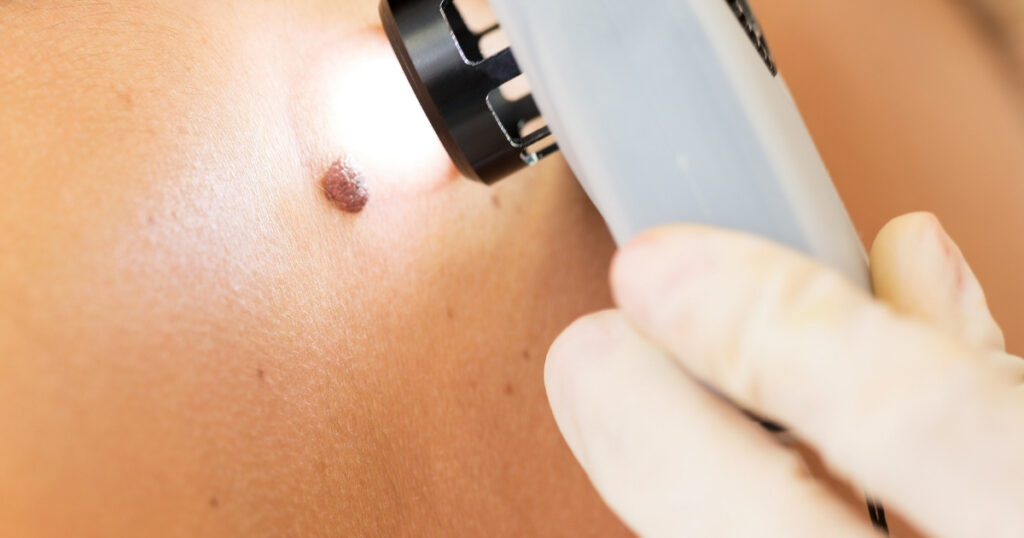 Melanoma